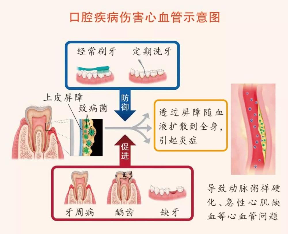 一张“示意图”告诉你，牙不好是怎样连累心血管的