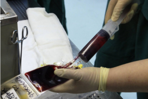山东省脐血库成立20年，已储存脐带血40余万例