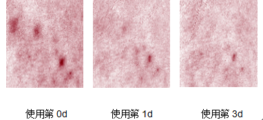 “战痘”多年，汝新美肌胶原蛋白安瓶精华面膜会是终结者？