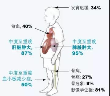 又一罕见病被攻破——脐带血成为戈谢病有效的治疗手段