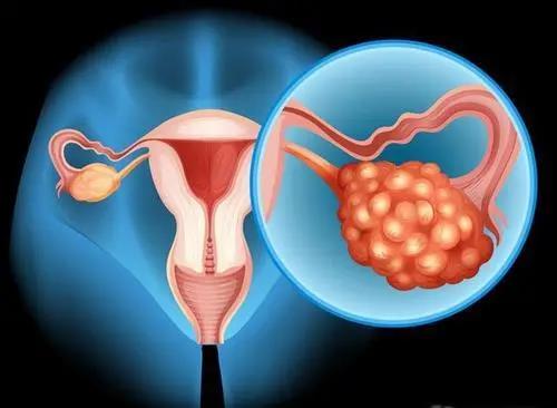 卵巢恶性肿瘤居于妇科肿瘤榜首，济南杏林中医院提醒你注意四个早期症兆