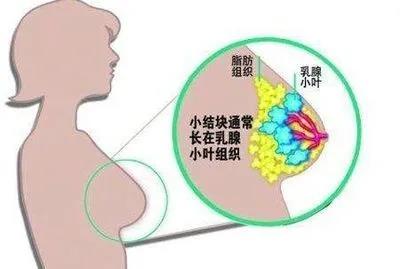 济南杏林中医院丨确诊乳腺增生，多用这些泡水喝可通乳散结