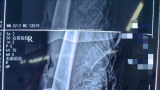 山一大一附院骨创伤外科成功救治一例膝关节离断伤患者