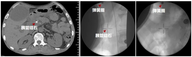 国内首例！山大齐鲁医院消化科超声内镜介入治愈肝总动脉瘤