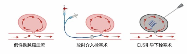 国内首例！山大齐鲁医院消化科超声内镜介入治愈肝总动脉瘤