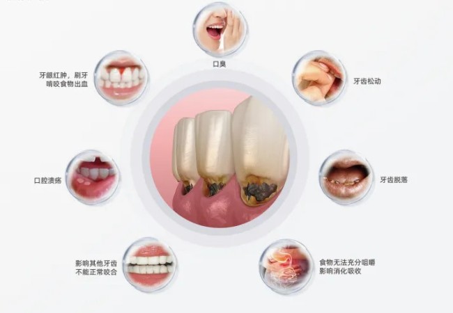 一年四次，远离掉牙——可恩口腔PMTC口腔除菌护理，10步除菌“0疼痛”