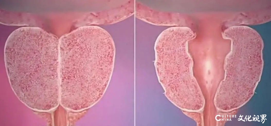 山东大学齐鲁医院泌尿外科首次使用前列腺“水刀机器人”成功完成两例良性前列腺增生切除手术