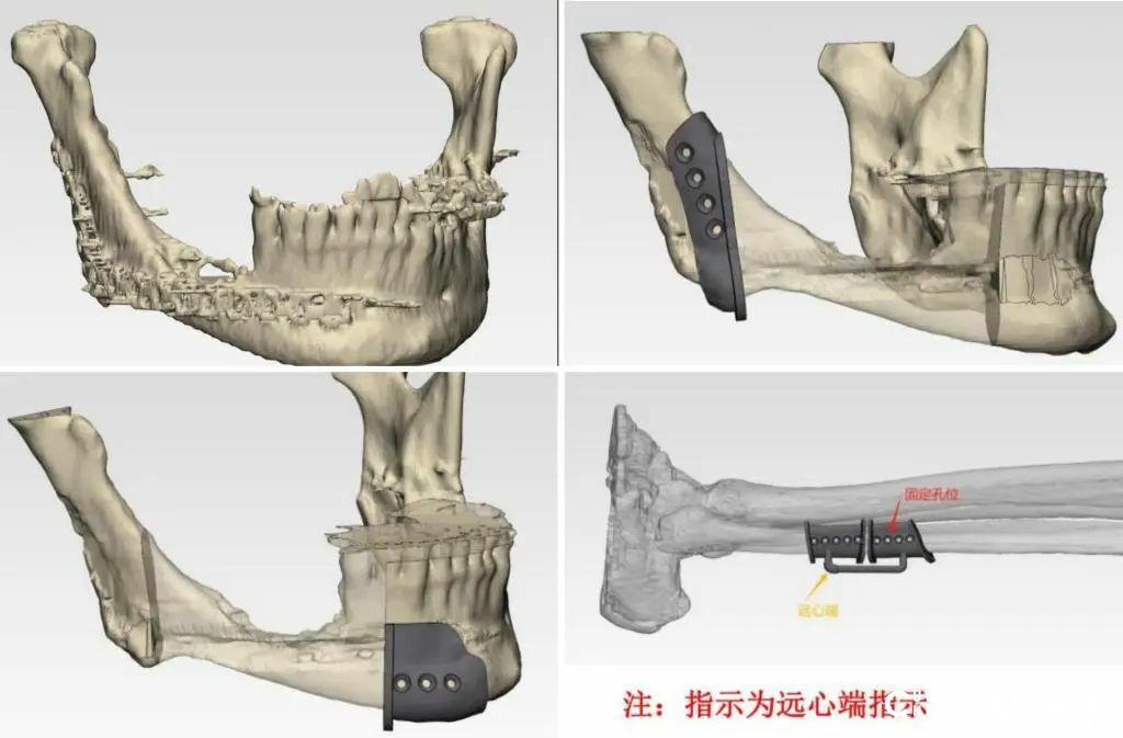 国内首例！山大齐鲁医院口腔科成功实施数字化3D打印钛板下颌骨重建手术