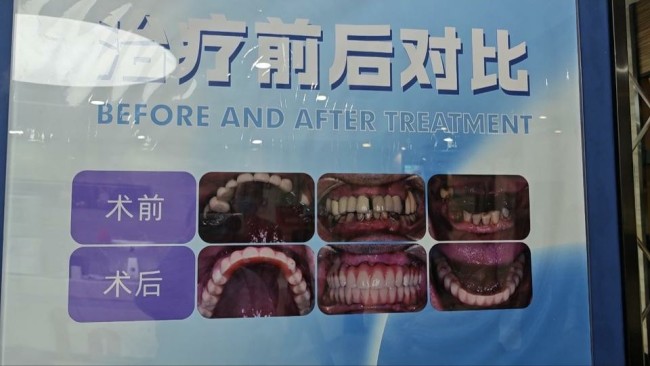 3·15在行动丨近7万元的“即刻负重”种植牙没做成功，反复修复一年多致患者牙床受损——潍坊可恩口腔竟称只能赔付3000元