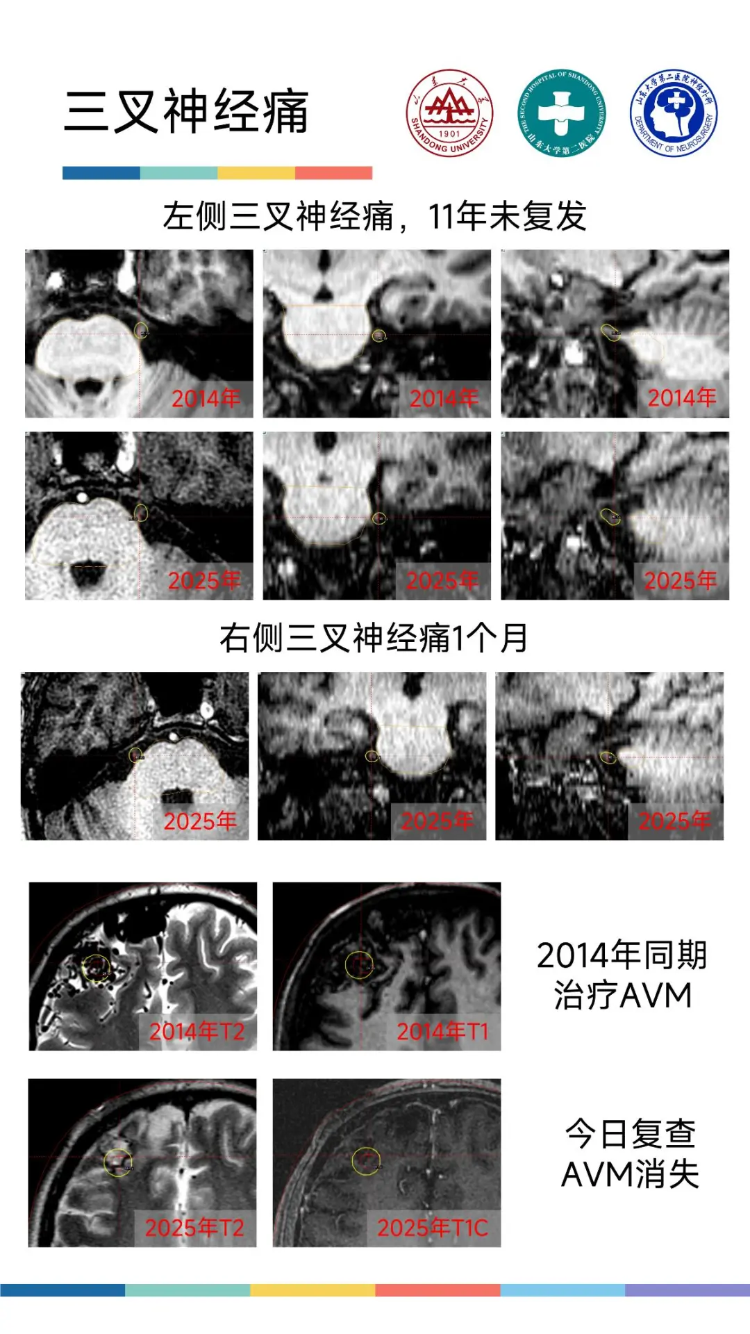 “天下第一痛”？山大二院神经外科：“轻松拿捏”！