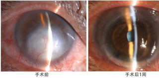 重启清晰视界！山东省千佛山医院眼科成功开展穿透性及深板层角膜移植手术