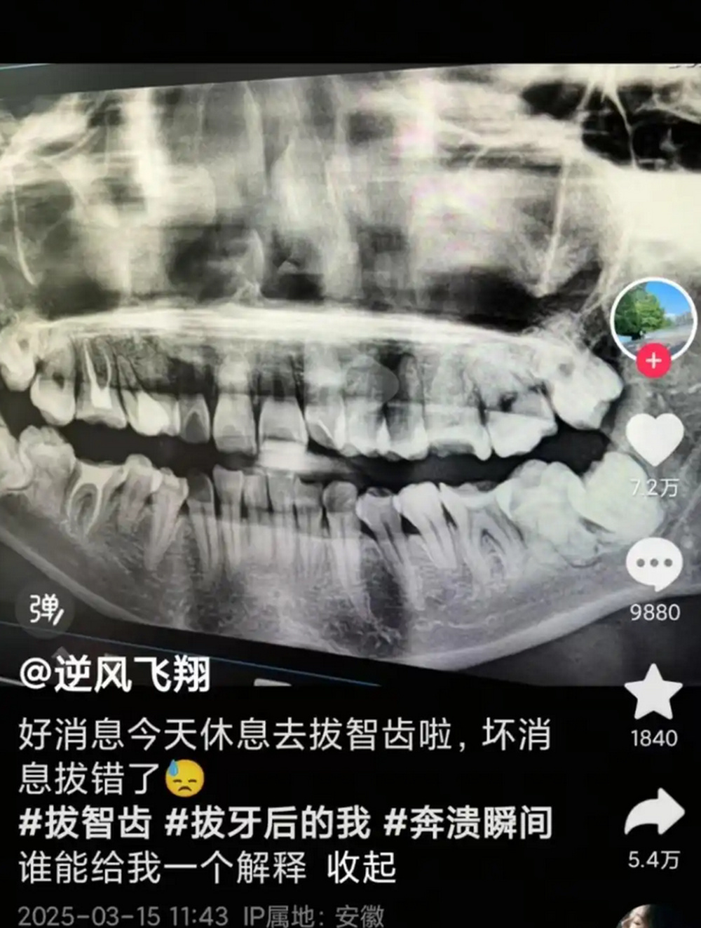 安徽一女子被拔错牙后坠楼身亡？家属：好牙位置没打麻药，硬生生拔下来
