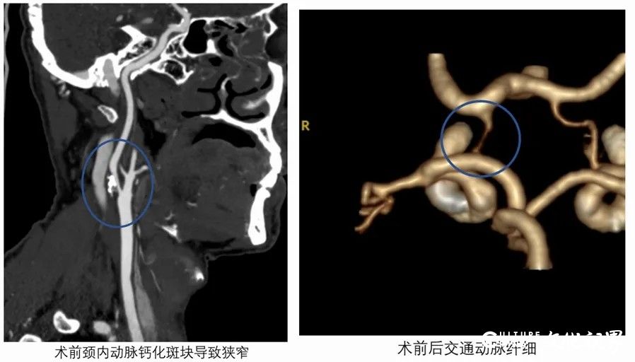 山东大学第二医院完成高风险颈动脉内膜剥脱术，解除六旬患者脑梗风险