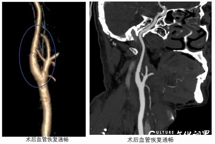 山东大学第二医院完成高风险颈动脉内膜剥脱术，解除六旬患者脑梗风险